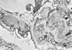 M,53y. | type III membranoproliferative glomerulonephritis